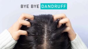 Dandruff Remedies Natural Solutions for an Itchy Scalp