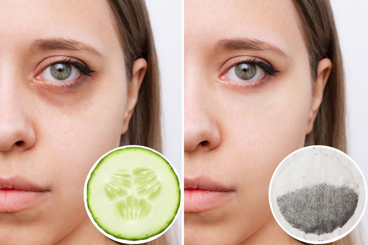 Natural Remedies for Dark Circles and Puffy Eyes